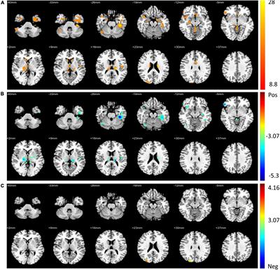 Reconfiguration of Functional Dynamics in Cortico-Thalamo-Cerebellar Circuit in Schizophrenia Following High-Frequency Repeated Transcranial Magnetic Stimulation